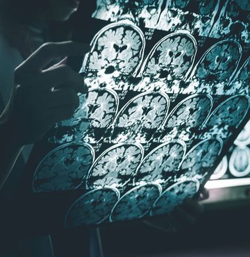 Japon hükümeti, Alzheimer hastalığının belirtilerini teşhis edebilen kan testi kiti için kullanım onayı verdi