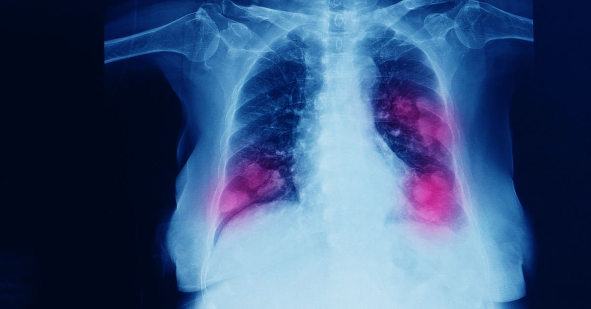 Tuberculosis is still a major health problem.