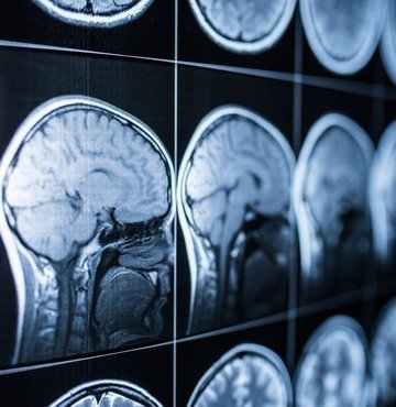 Kanada’nın Toronto kentindeki iki hastanede görev yapan doktorlar, ortaklaşa yürüttükleri bir çalışmayla bir çocukta ameliyat edilemeyen beyin tümörüne, dünyada ilk kez kullandıkları teknikle kemoterapi uygulamayı başardı