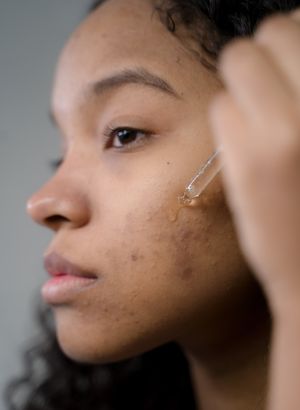 Yüzünüzdeki koyu lekelerden kurtulun! İşte 3 basit yöntem