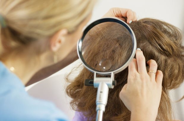 Saç biti nasıl temizlenir?