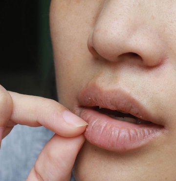 Özellikle hassas ve kuru cilde sahip kişilerde dudak kuruluğu sıklıkla görülür. Oldukça can sıkıcı bir durum olan dudak kuruluğu mevsimsel değişikliğe bağlı olabileceği gibi vitamin eksikliğinden kaynaklı olarak ya da bir hastalığın belirtisi olarak da karşımıza çıkabilir. Cilt problemleriyle sıklıkla uğraşan kişiler de bu durumdan oldukça şikayetçidir. Dudak kuruması hassas cilt problemlerinden olabileceği gibi ciddi hastalıkların habercisi de olabilir. Peki dudak kuruması neden olur? Dudak kurumasında nelere dikkat edilmesi gerekir? İşte dudak kuruluğunda tedavi yöntemleri…