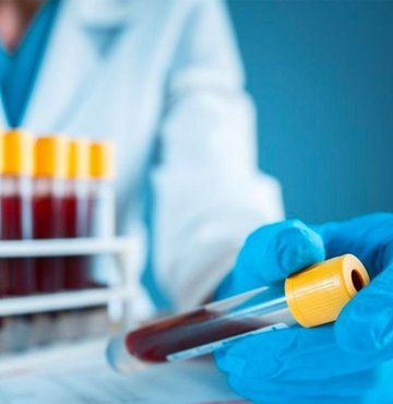 Alzheimer tanısında yeni altın standart! Basit bir kan testiyle doğru ve tutarlı sonuç