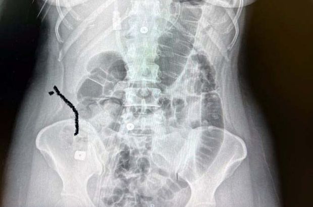 Boynuna takılan implant yemek borusunu yırtıp midesine düştü