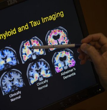 ABD Gıda ve İlaç Dairesi (FDA), Alzheimer