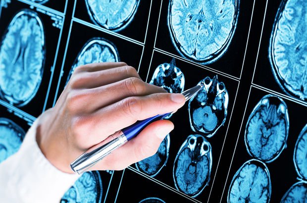Alzheimer parmak ucundan alınan kanla teşhis edilebilecek mi?