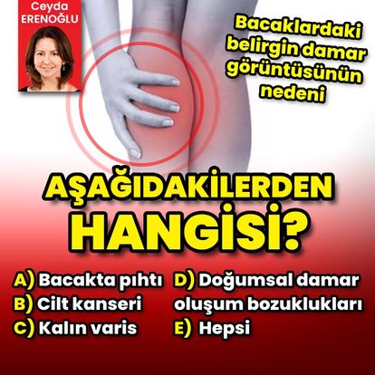 Bacaklardaki belirgin damar görüntüsü; bacakta pıhtı oluşumu, cilt kanseri, kalın varis, doğumsal varis oluşumları ile bunların dışındaki pek çok nedenden kaynaklanabilir