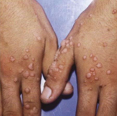 Siğil için dua ve yakma, böcek ısırması için ısırılan bölgeye tükürme, şeker, yoğurt, kolonya, çamur ve paslı demir sürme, geleneksel tedavi yöntemleri arasında bulunuyor. -