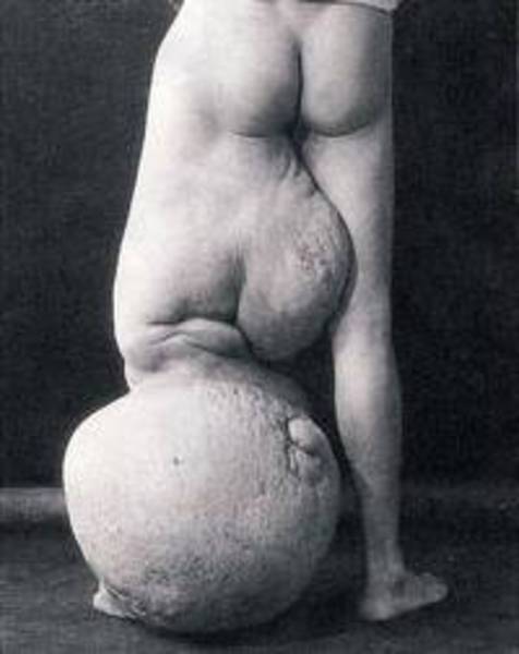 Lenfatik filaryaz dünya çapında halen 120 milyon insanı etkiliyor ve bunların 40 milyonu bu hastalığın ciddi boyutundadır. Enfeksiyonlu dişi bir sivrisinek bir insanı ısırdığında, mikrofilarya denen kurt larvalarını kana enjekte edebilir. Mikrofilarya tekrar tekrar ürer ve uzun yıllar boyu yaşayabileceği kan dolaşım yoluna yayılır. Sık görülen hastalık belirtileri enfeksiyon sonrası yıllara kadar gözükmez. Parazitler kan damarlarına yerleştiği gibi sirkülasyonu kısıtlayabilir ve çevresindeki dokularda kanın birikmesine neden olabilir. Enfeksiyonun en genel görülen belirtileri aşırı derecede büyümüş kollar, bacaklar, genitalya ve göğüslerdir.  -