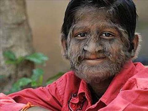 Bu hastalığa kurtadam sendromu denir çünkü hasta olan kişiler keskin dişler ve pençeler dışında kurtadama benzerler. -