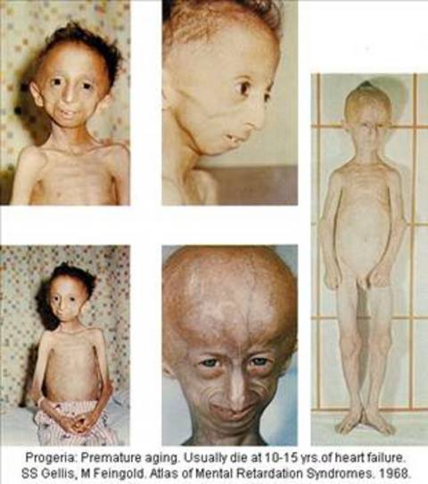 Progeria nadir görülen bir hastalıktır. Dünyada sadece bu hastalığa sahip yaşayan 48 insan bulunmaktadır. Bunun yanında, 5 çocuğu bu hastalığa sahip bir aile vardır. -