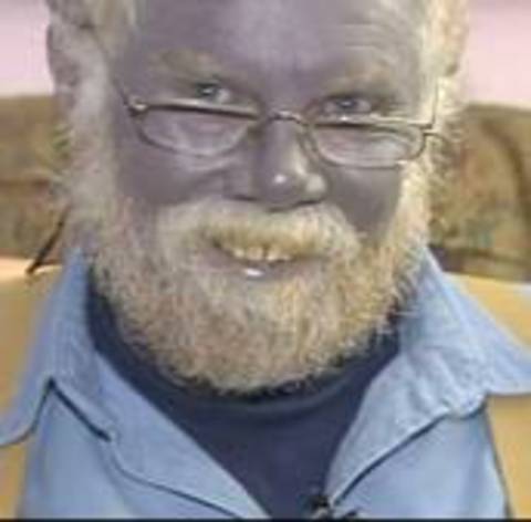 4- Mavi Ten rahatsızlığı: Mavi insanlar -  - Mavi insanlar olarak bilenen büyük bir aile 1960'lara kadar Kentucky'deki Troublesome deresi çevresindeki tepelerde yaşamışlardır. Onlar mavi fügetlerdi. Çoğu 80 yaşını geçmiş ve mavi ten dışında ciddi bir hastalık geçirmemiştir. -