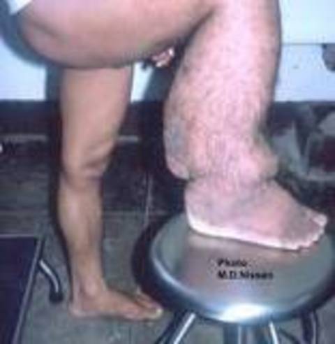 Sıcak ülkelerde fil hastalığının kökünü kazımanın en etkili yöntemi, larvaları taşıyan sivrisineklerin yayılmasını ve üremesini önlemektir. Tehlikeli bölgelere yapılan gezilerde sivrisineklere karşı cibinlik altında uyumak ve böcek ilacı kullanmak gibi önlemler alınmalıdır.  -