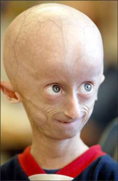 2- Progeria: 80 yaşındaki çocuk sendromu -  - Progeria'ya bir çocuğun genetik şifresindeki ufacık, basit bir kusur neden olabilir ama yıkıcı ve hayatını değiştiren sonuçlara yol açar. -