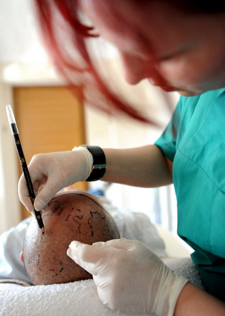 Saç Ekimi Operasyonunda Bunlara Dikkat! -  - Saç ekimi operasyonundan sonra yara kabukları dökülene kadar saçları yıkarken dikkat etmek gerekiyor. Ayrıca her yaşa uygulanabilen saç nakli, şeker ve tansiyon hastalığı, diyaliz gerektiren böbrek rahatsızlığı, karaciğer ya da ağır kalp hastalığı olan kişilerde sakıncalı…