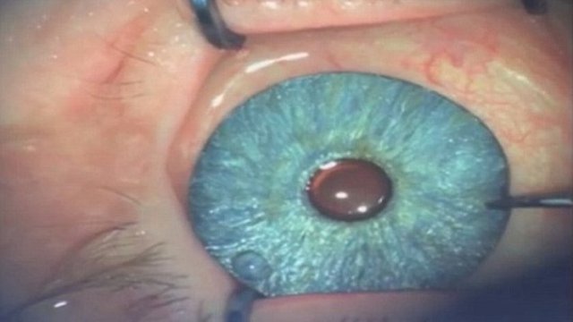 Günümüzde insanlar bir lazer ameliyatıyla göz renklerini istedikleri bir renge temelli olarak dönüştürebilirler.