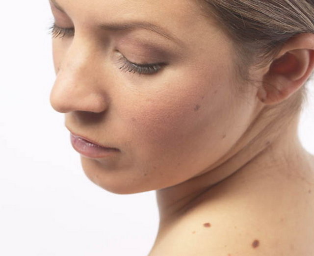 Sigara - Sigara içmek kan dolaşımını olumsuz etkiler, vücuttaki C vitaminin azlmasına neden olur, hücrelerin oksijensiz kalmasına sebep olur bu nedenle hücre kendini yenileyemez, cilt elastikliğini kaybedip kalınlaşır -