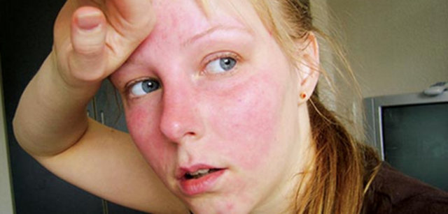 Yüz kızarmasından korkma (eritrofobi)