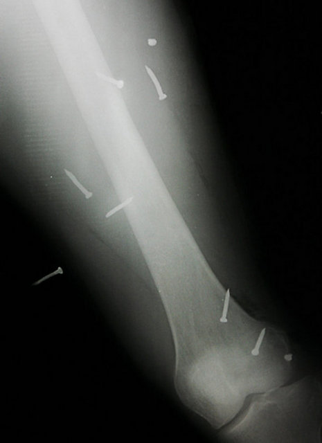 Bir savaş gazisinin rontgeni.