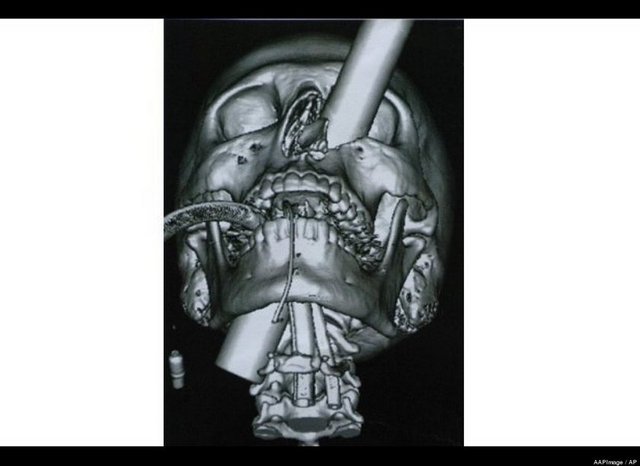 Kafatasına sandalye bacağı giren adam hastanede bir aylık bir tedavi süreci geçirdi.