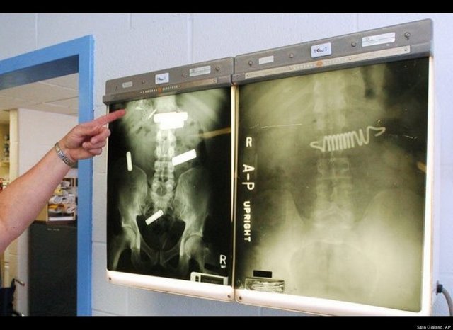 Bir hapishanenin mahkumlarının rontgen görüntülerinde yatak yaylarından pile kadar herşey mevcut.