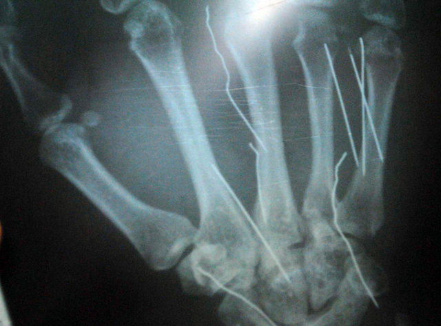 Sri Lanka'lı kadın ellerine tam 14 iğne batırdığı rontgenlerde meydana çıktı.