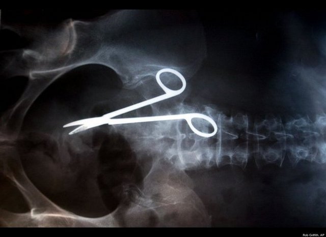 Avusturyalı kadın ameliyat sonrası içinde unutulan makasla 18 ay yaşadı.