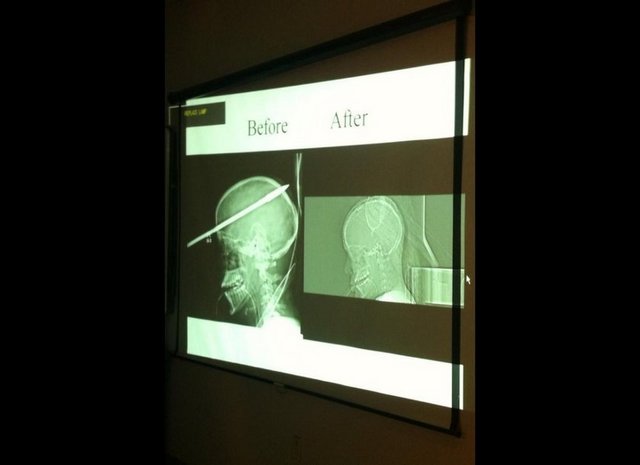 Miami'li gençe kafasına saplanan metale rağmen hayatta kaldığı için şanslı sayılanlardan...