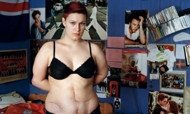 Eirin Kristin Kjær (20) Laksvatn'da yaşıyor; karın bölgesine üç kurşun isabet etti. Kendisinden daha küçük olanları korumaya çalışırken vuruldu. Saldırının en somut izi olan ameliyat izlerini göstermekten çekinmiyor.