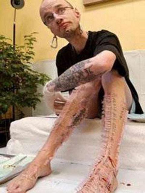 Kanadalı bu genç adam ise Guinness Rekorlar Kitabı'na girmek için hiç denenmemiş bir yöntem buldu. Bir buçuk saat içinde vücuduna 1.000 tane iğne batırarak kaktüs adam olma rekorunu kırdı.