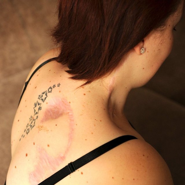 SAĞLIK SERVİSİ / HABERTURK.COM  27 yaşındaki üç çocuk sahibi genç anne, haftada üç kez güneşlendiği için cilt kanseri oldu...