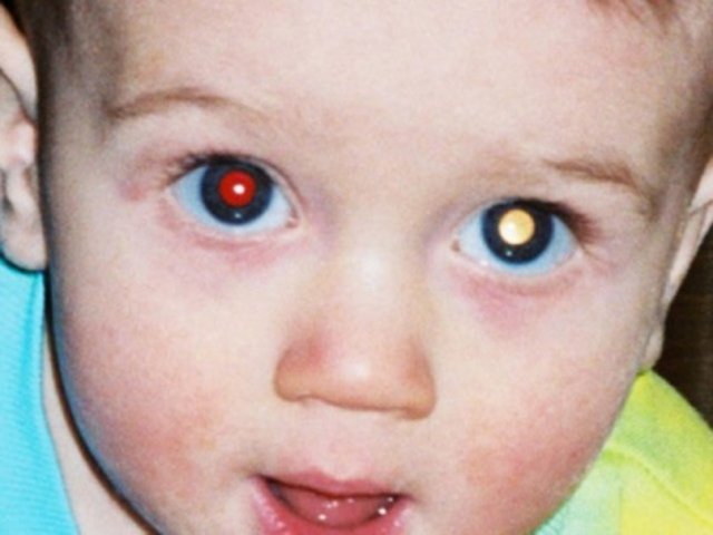 Durul, erişkinlerdeki en sık görülen birincil göz içi tümörü olan melanomun ise genellikle erken dönemde belirti vermediğini kaydetti.