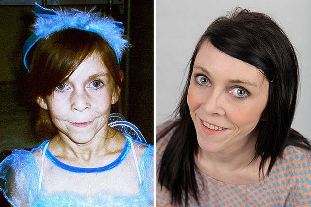 İngiltere'nin Yorkshire kentinde yaşayan 16 yaşındaki Zara Hartshorn, doğuştan yakalandığı"Benjamin Button Sendromu" olarak da bilinen lipodystrophy hastalığı nedeniyle 60 yaşında görünüyor.