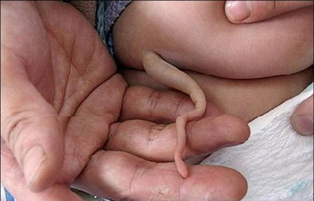 Modern tıpta meningocele adı verilen hastalık, derinin altına gizlenmiş olan, üç ya da dört omurun kaynaşmasıyla ortaya çıkıyor...