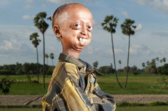 Hindistan'da yaşayan ve daha önce 5 kardeşini birden bu hastalığa kurban veren 14 yaşındaki Ali Hussain, vücudun normalden 8 kat daha hızlı yaşlanmasına neden olan Progeria hastalığından müzdarip.