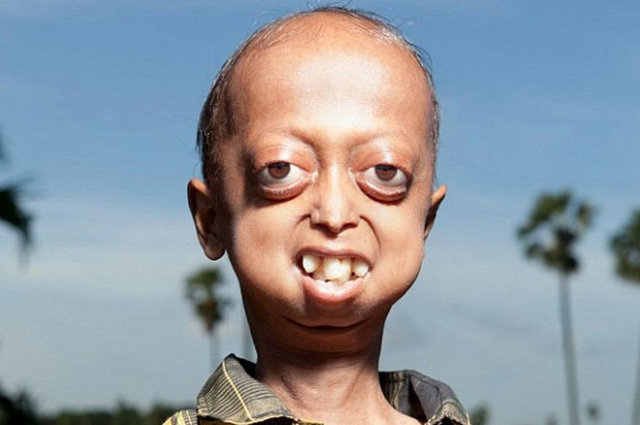 Bu hastalık dünyada yalnızca 80 kişide görüldü. Genellikle 14 yaşına gelmeden ölümlere neden oluyor.