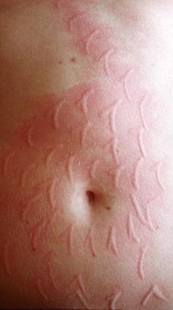 Tam olarak nedeni bilinmeyen ve "cilt yazısı" olarak da adlandırılan hastalık bir çeşit ürtiker.