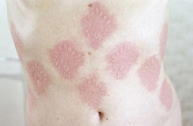 Deride herhangi bir yer kaşındığında anında kızarıklıklar ve kabarcıklar ortaya çıkıyor ve yaklaşık yarım saat sürüyor.