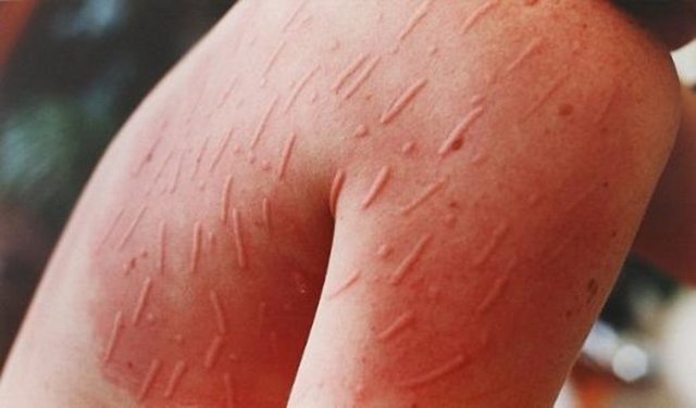 Ancak 34 yaşındaki Russel, kesin tedavisi olmayan bu hastalığından zaten memnun.