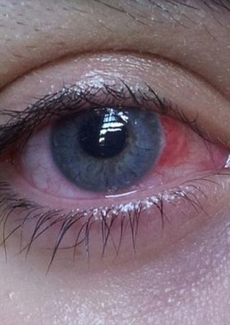 Dr. David Allamby ise, bu tip lenslerle uyunduğu takdirde gözde enfeksiyon riskini artacağına dikkat çekerek, bu lenslerin göze kalıcı hasarlar verebileceğini söylüyor ve insanları dikkatli olmaları konusunda uyarıyor.