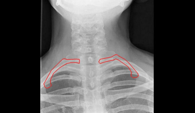 Her 20 kişiden birinin ve çoğunlukla da erkeklerin kaburga sayısı 1 fazla.