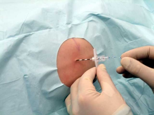 Epidural ağrılarınızı tam olarak kesmeyebilir.