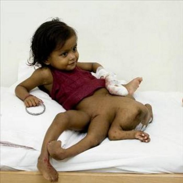 8 BACAKLI KIZ -  -  -  - 2005 yılında Hindistan'ın fakir bir köyünde dünyaya gelen küçük kız herkesi şaşırtmayı başardı. Dört kollu ve dört bacaklı olarak dünyaya gelen Lakshmi Tatma, 30 ameliyat geçirdi. Küçük kızın hala geçirmesi gereken ameliyatlar var.