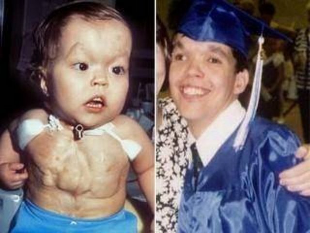 KALBİ GÖĞSÜNDE ATIYOR -  -  -  - Christopher Wall doğduğu günden itibaren kalbi göğüs boşluğunun dışında atıyor. Doktorlar küçük çocuğun yaşayacağını dahi umut etmezken Wall, 34. doğumgününü kutlamayı başardı. Wall daha 18 aylıkken doktorlar kalbinin yerini değiştirmeye çalıştılar ve tan 15 ameliyat yaptılar. Fakat bunun çok büyük riskler taşıdığı görüldü ve bundan vazgeçilerek kalbin bulunduğu bölüm daha kalın bir deriyle kaplandı.