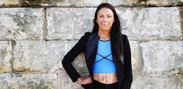 2011'de yaşadığı elim kaza sonrası hayata sıkı sıkıya tutunan 26 yaşındaki Pitt, gelişmemiş ülkelerde ihtiyacı olan insanların estetik ameliyat...