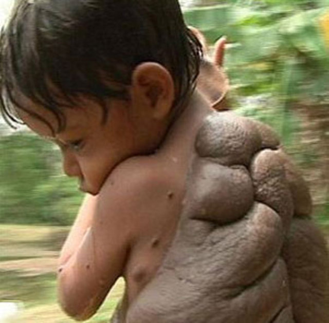 Sırtı kaplumbağa kabuğuna benzeyen bir et beni ile kapladıktan sonra 'kaplumbağa çocuk' olarak anılmaya başlandı...