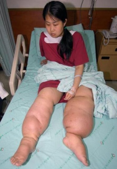 Fil Hastalığı (Elefantiyazis): Kabaca Genişleyen Uzuvlar Elefantiyaz olarakta bilinen Lenfatik filaryaz, en çok kabaca genişlemiş yada şişmiş ayaklar ve kollara sahip dramatik insan fotoğraflarından bilinir.