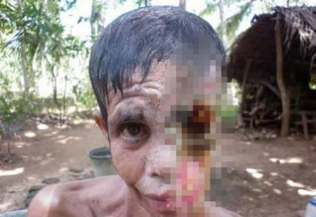 Sabaha karşı şişmiş ve yüksek ateşle hastalanan kadın, hastaneye kaldırıldı. Kadının vücuduna et yiyen virüs girdiği söylendi.