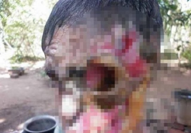 Gözünü ve yüzünün yarısını kaybeden kadını görenler gözlerine inanamıyor