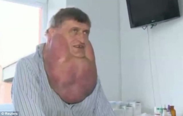 Slovakya'da Stefan Zoleik isimli kişi, yüzünde çıkan 6 kiloluk tümör nedeniyle ameliyata alındı...